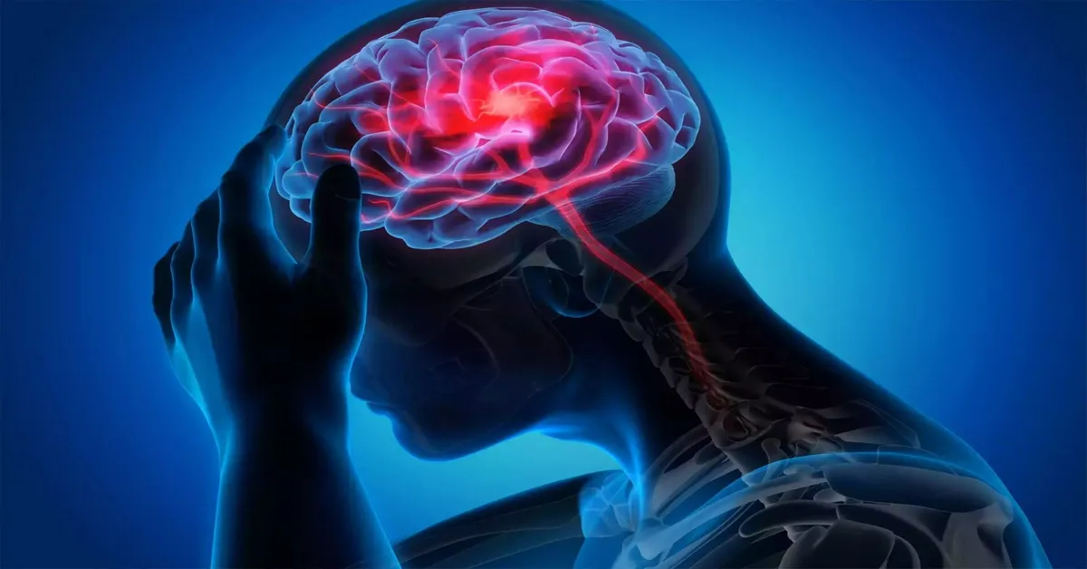 Brain Stroke