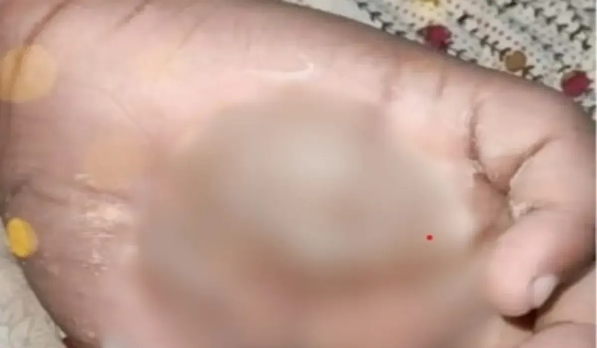 Teacher ने मासूम बच्चे का जलाया हाथ