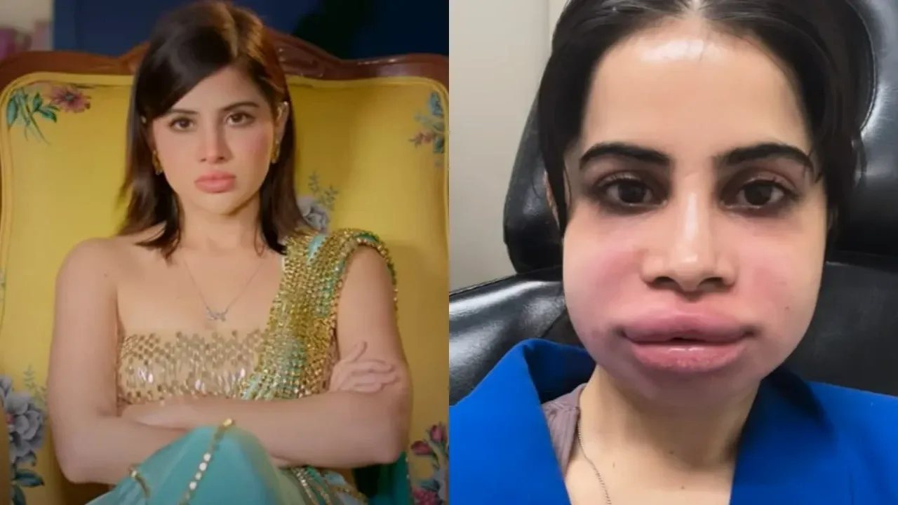 Urfi javed lip fillers