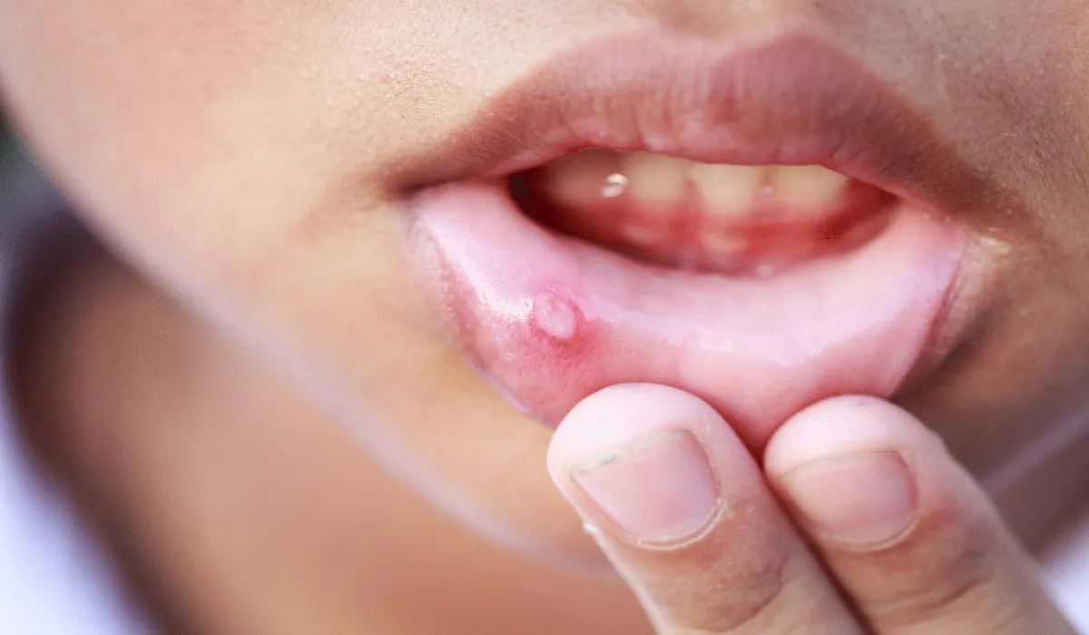 Mouth Ulcers Causes