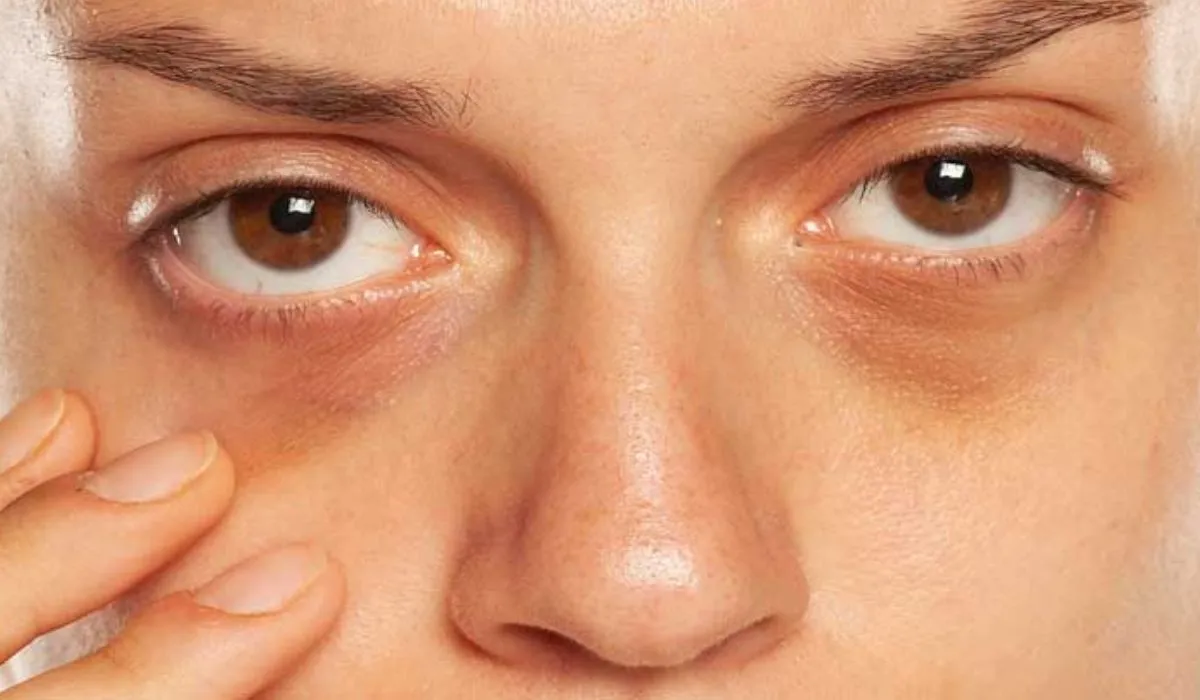 Dark Circles Health Warning