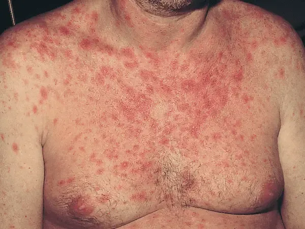 AIDS Diwas Controversy