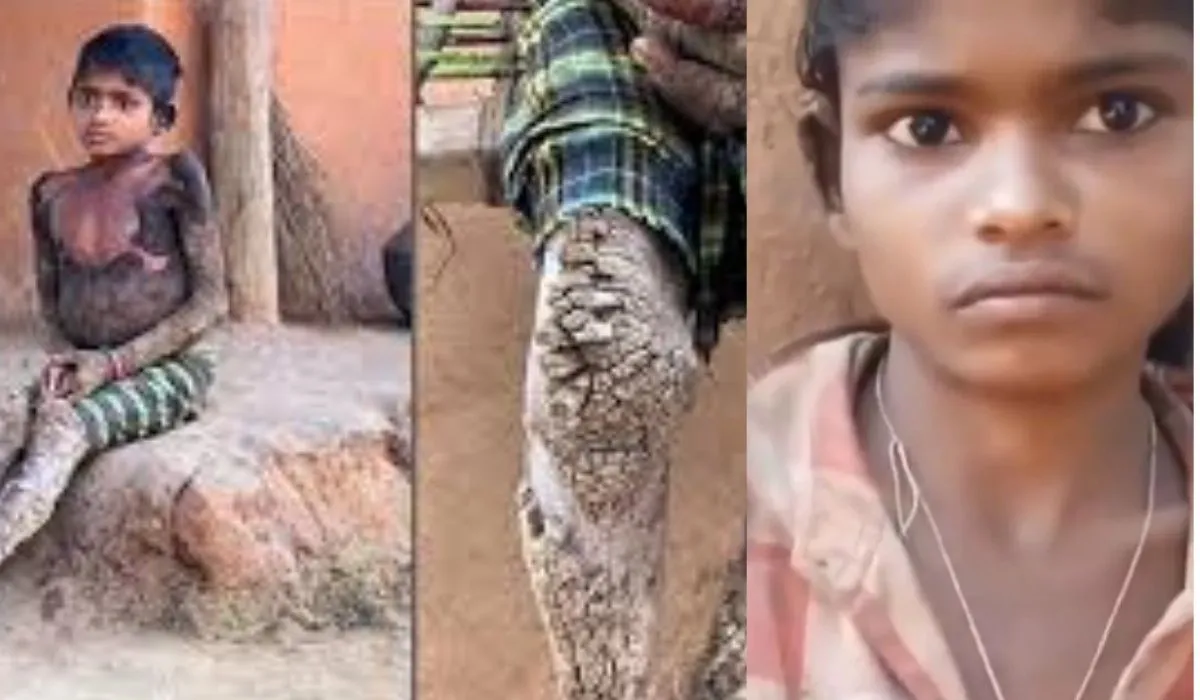 Chhattisgarh Stone Man Syndrome Case
