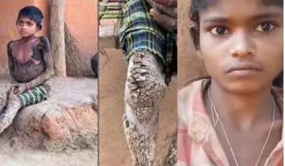 Chhattisgarh Stone Man Syndrome Case