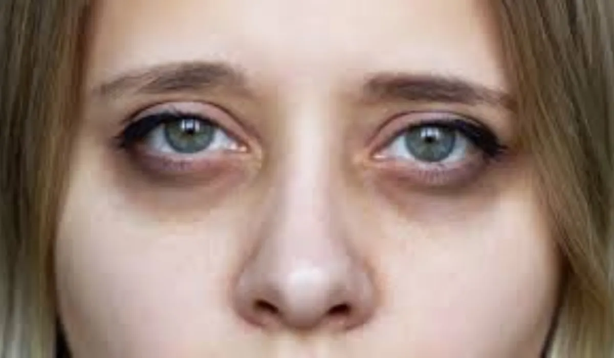 Home Remedies for Dark Circles