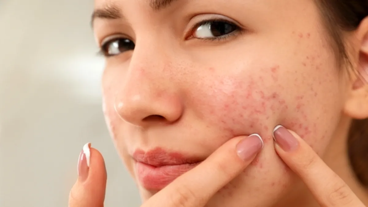 Home Remedies for Skin Redness (2)