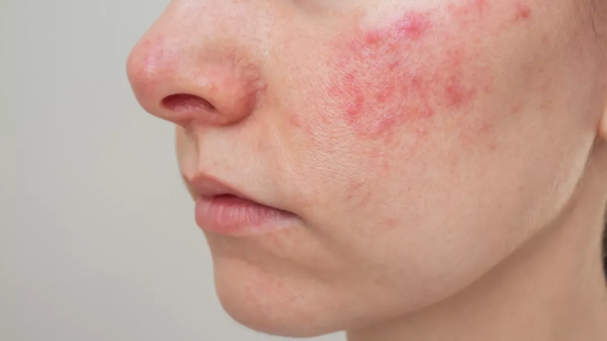 Home Remedies for Skin Redness