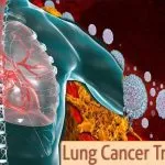 Lung Cancer Immunotherapy Treatment