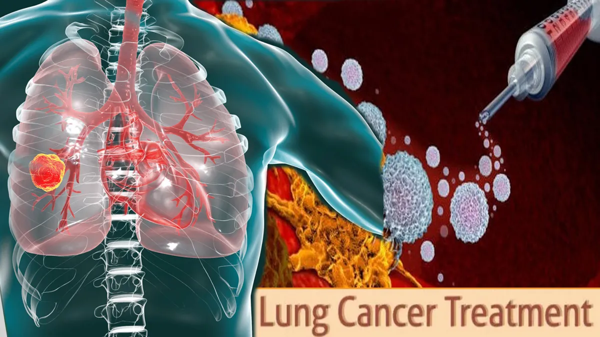 Lung Cancer Immunotherapy Treatment: लंग कैंसर के इलाज में नई क्रांति ...