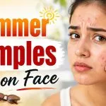 Summer Pimples on Face
