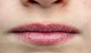 Dry Lips in Summer