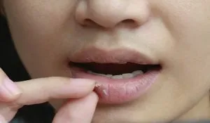 Dry Lips Treatment at Home