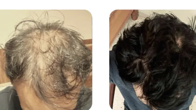 Traya Hair Treatment