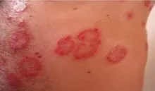 skin